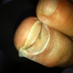 Stalen nagelbeugel om nagel te corrigeren